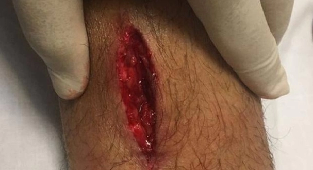 Roma, Perotti mostra il taglio sulla gamba: Ecco perché ho sbagliato il rigore [FOTO]