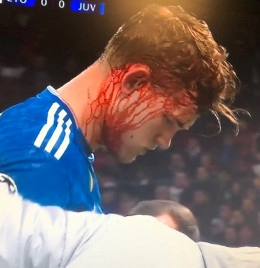Lione-Juventus, brutto infortunio per De Ligt: l'olandese &egrave; una maschera di sangue - FOTO